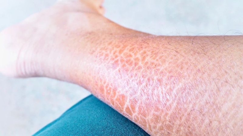 Bệnh vảy cá có lây không? Nguyên nhân và cách điều trị bệnh vảy cá 3