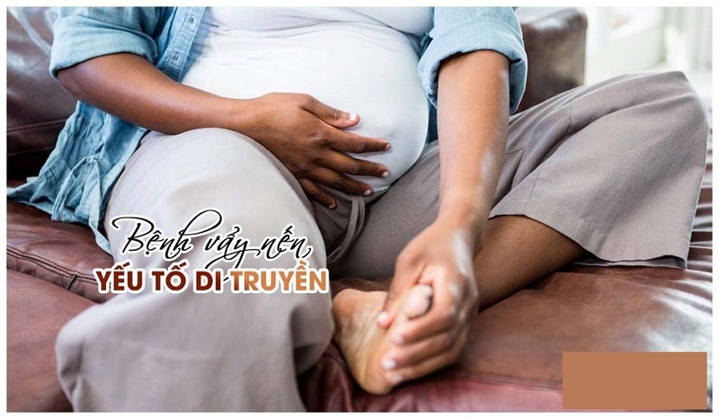 Thực hư bệnh vẩy nến có di truyền không? 2