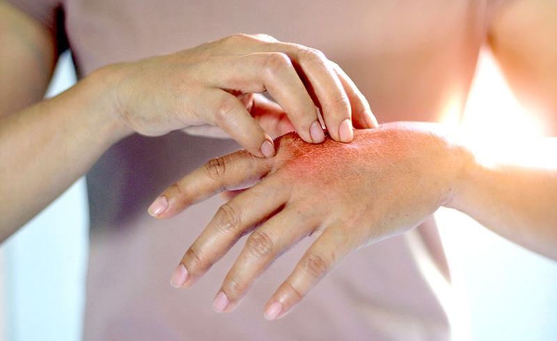 benh-vay-nen-co-nguy-hiem-khong-trieu-chung-cua-benh-vay-nen 1