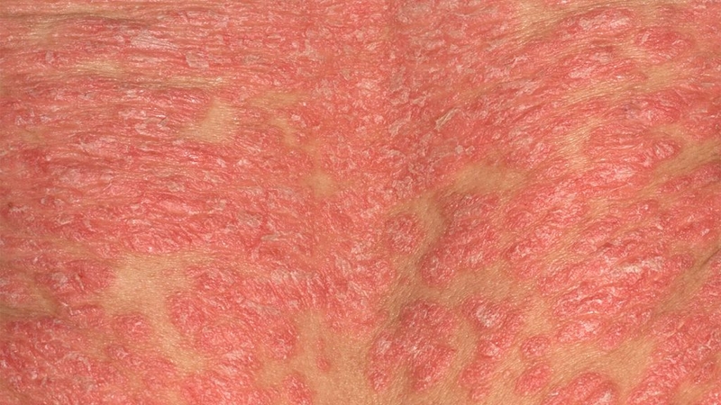 Bệnh vảy nến hồng có nguy hiểm không?