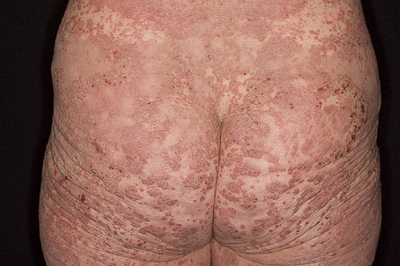 Cách chữa trị bệnh vảy nến ở bộ phận sinh dục 1