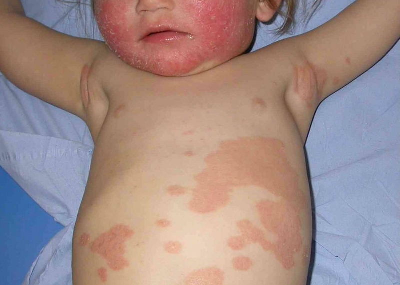 bệnh vẩy nến ở trẻ sơ sinh 4