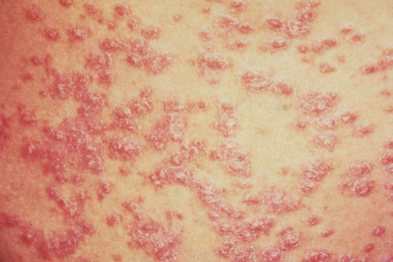 Tống quan về bệnh vảy nến thể mủ