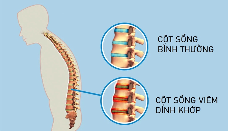 benh-viem-cot-song-dinh-khop-co-anh-huong-den-chuc-nang-sinh-san-khong-1.jpg