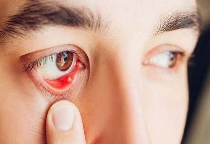 Bệnh viêm củng mạc: Nguyên nhân, triệu chứng, phương pháp chẩn đoán và điều trị 4