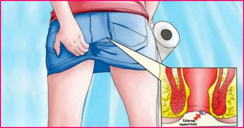 Bệnh viêm đại tràng và trĩ có gì khác nhau 3