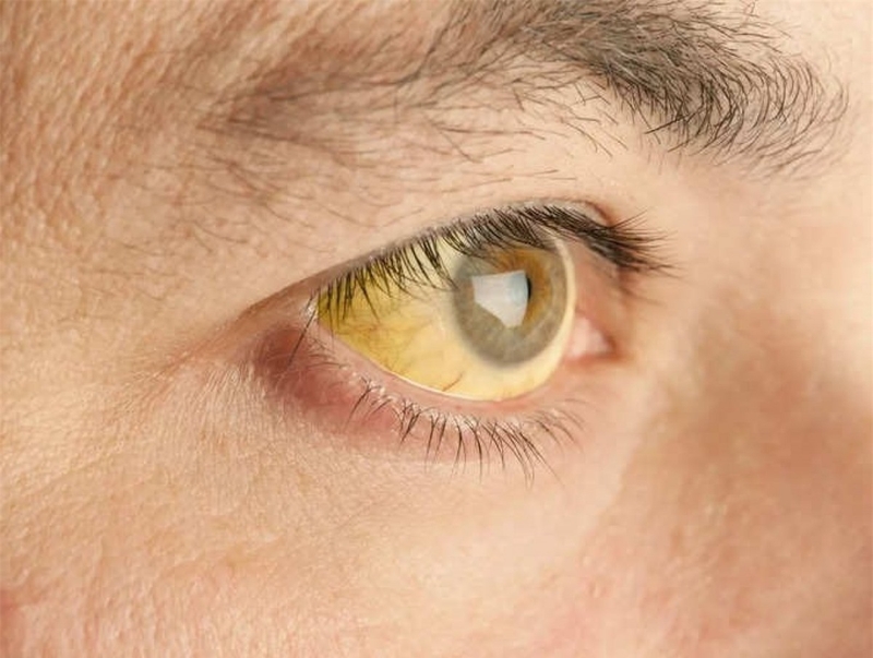 Bệnh viêm gan A lây qua đường nào