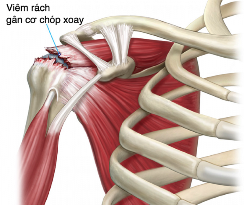 Bệnh viêm gân chóp xoay vai và phương pháp điều trị hiệu quả nhất hiện nay 2