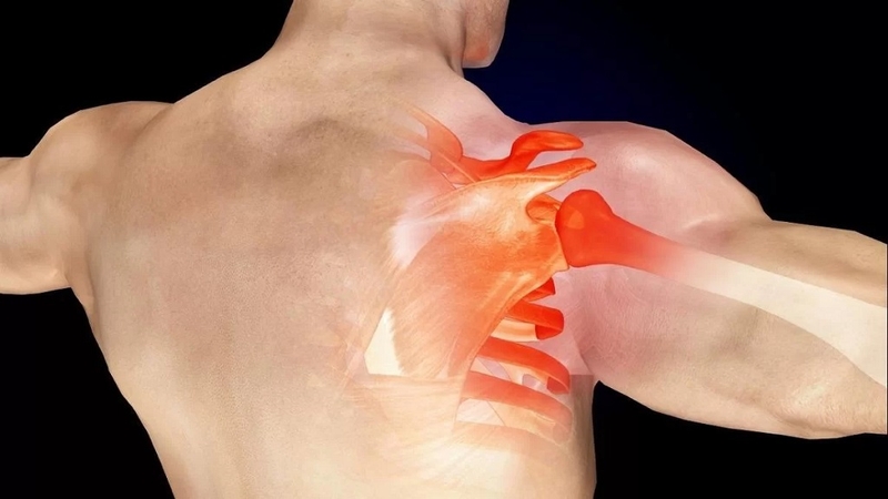 Bệnh viêm gân chóp xoay vai và phương pháp điều trị hiệu quả nhất hiện nay 3