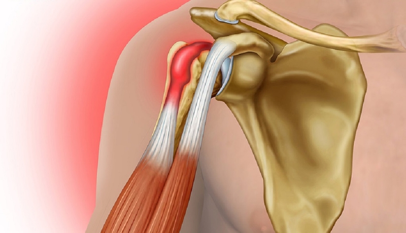 Bệnh viêm gân mạn tính: Nguyên nhân, triệu chứng và cách điều trị 1