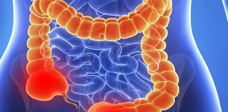 Bệnh viêm hồi tràng: Tìm hiểu nguyên nhân, triệu chứng, cách điều trị bệnh 2