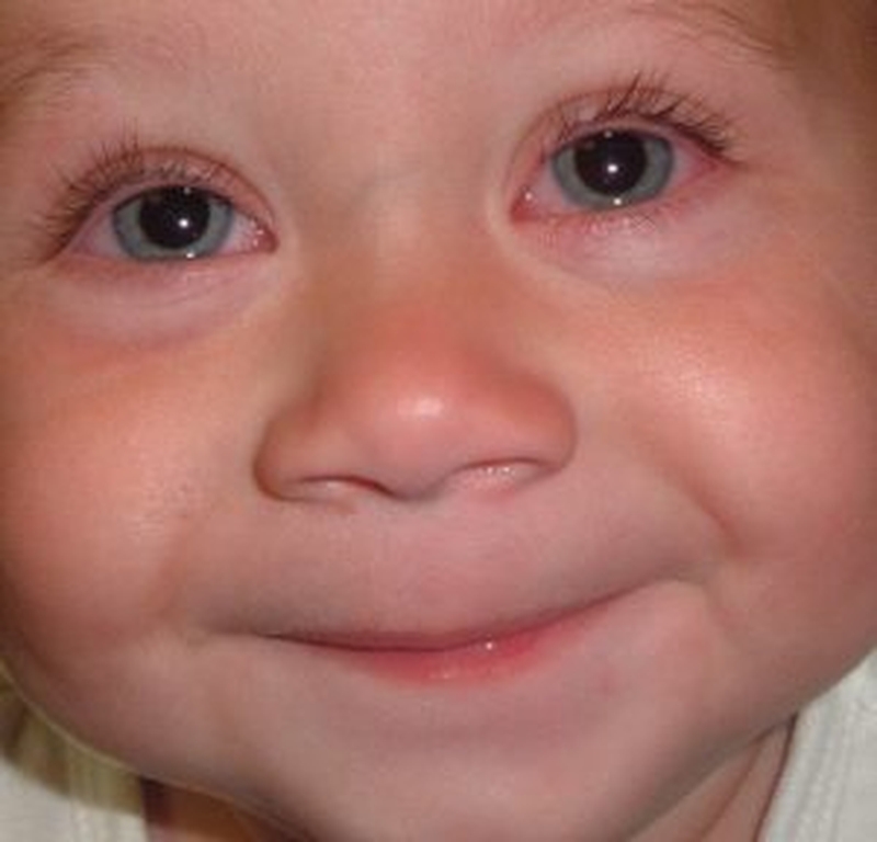 Bệnh viêm kết mạc ở trẻ, nguy hiểm đấy các mẹ chớ đùa 1 Bệnh viêm kết mạc ở trẻ, nguy hiểm đấy các mẹ chớ đùa 1