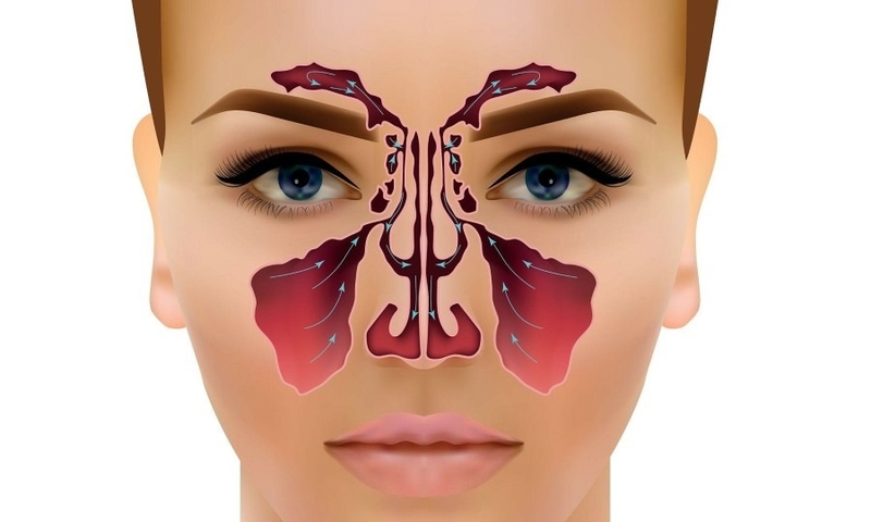Bệnh viêm mũi không dị ứng là gì? Có nguy hiểm không? 1