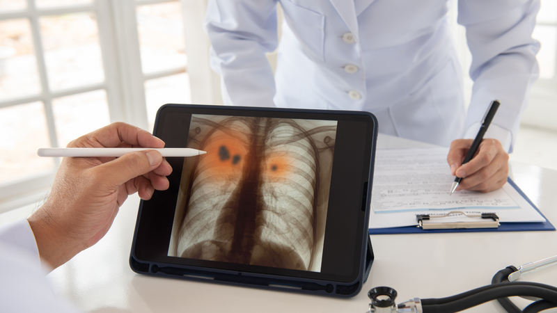 Bệnh viêm phổi có lây không? Lời giải đáp chi tiết dành cho bạn7