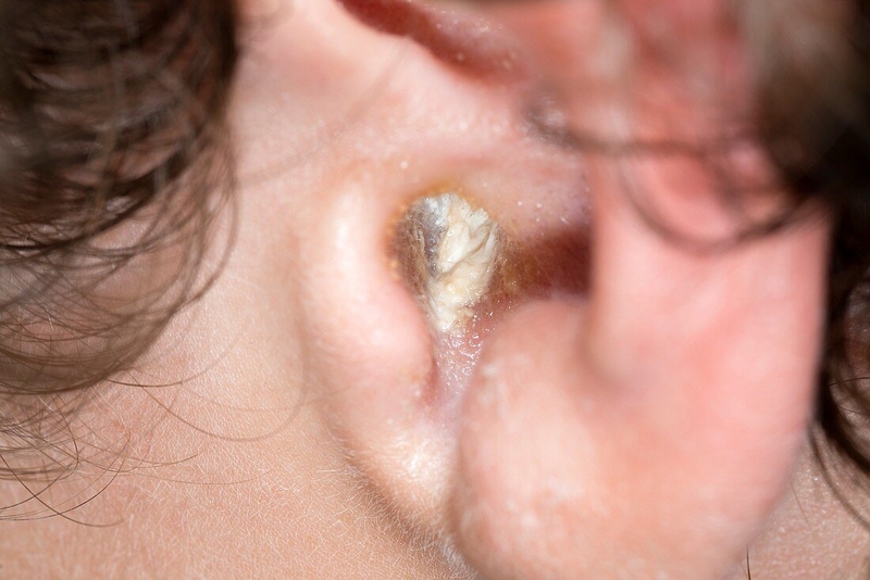 Bệnh viêm tai ngoài có tự khỏi được không hay cần phải điều trị? 1