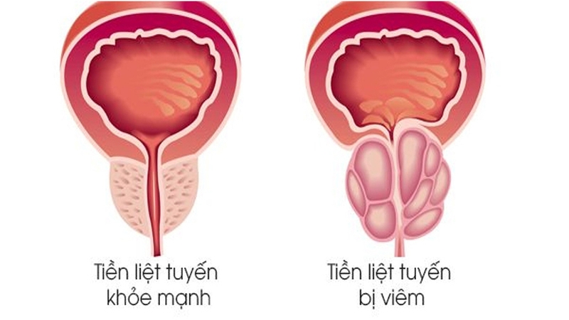Bệnh viêm tuyến tiền liệt có nguy hiểm không? 1