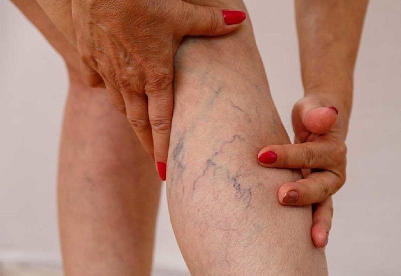 Bệnh vỡ tĩnh mạch nguy hiểm như thế nào? Cách xử trí khi bị vỡ tĩnh mạch 1