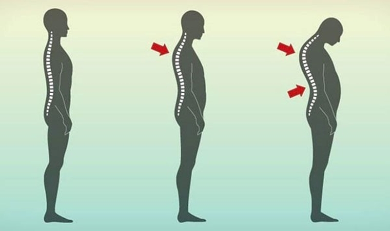 Bệnh võng lưng có chữa được không? Cách chữa võng lưng1