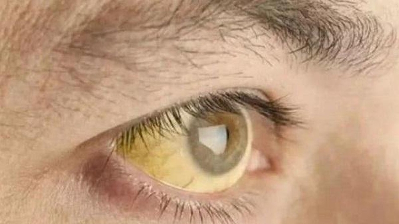 Bệnh Wilson là gì và những biểu hiện điển hình 1