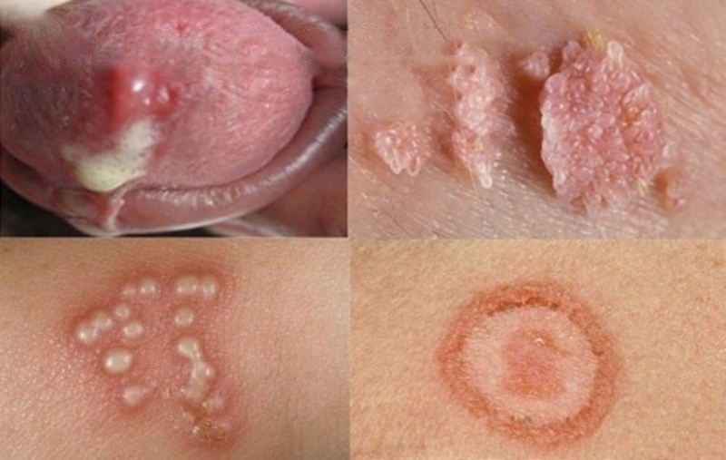 Bệnh xã hội gây ảnh hưởng đến sức khoẻ người mắc