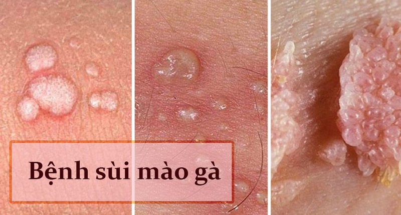 Bệnh xã hội phổ biến: bệnh sùi mào gà