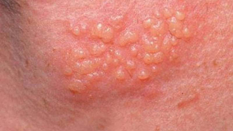 Bệnh xã hội là gì? Thời gian ủ các bệnh xã hội thường gặp là bao lâu? 4