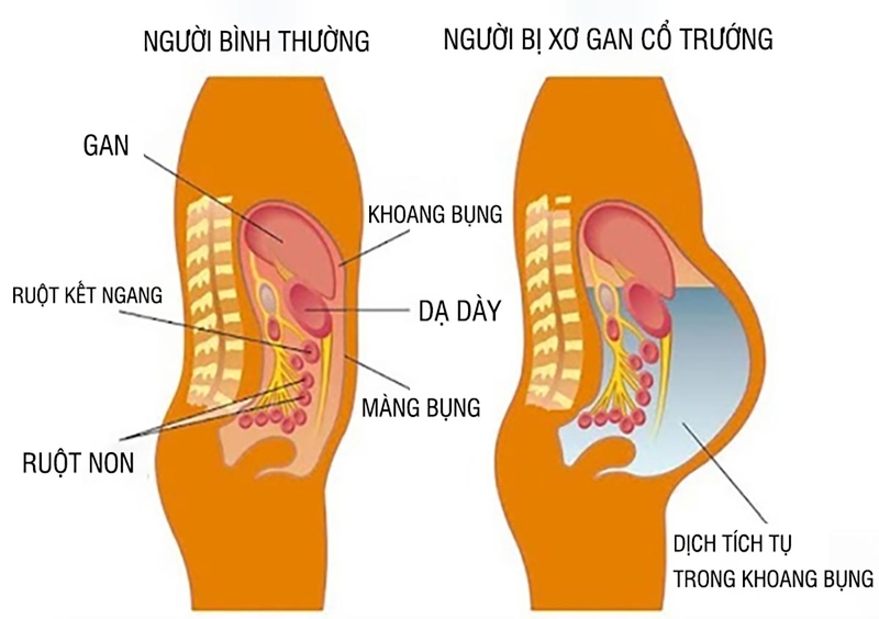 Bệnh xơ gan cổ trướng có chữa được không? 1