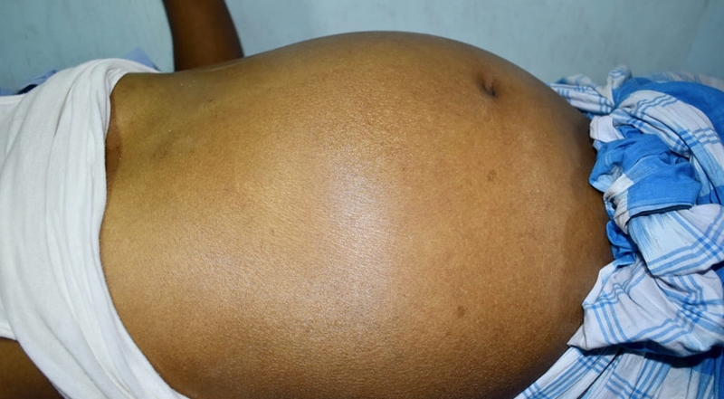 Bệnh xơ gan sống được bao lâu và 7 cách phòng ngừa bệnh hiệu quả 2