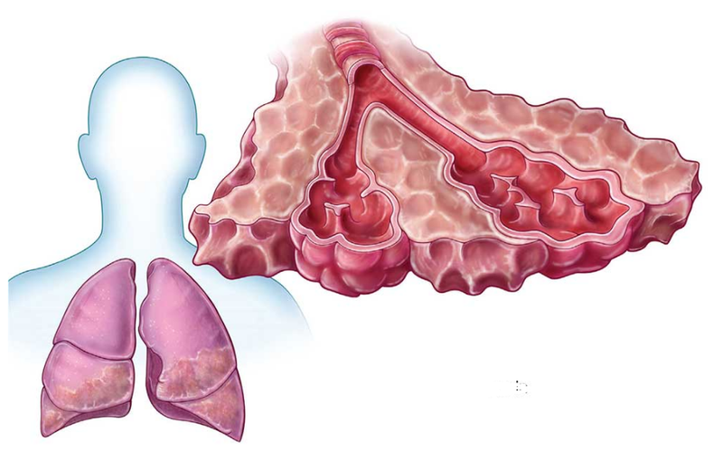 Bệnh xơ phổi có nguy hiểm không? Những phương pháp điều trị xơ phổi 2