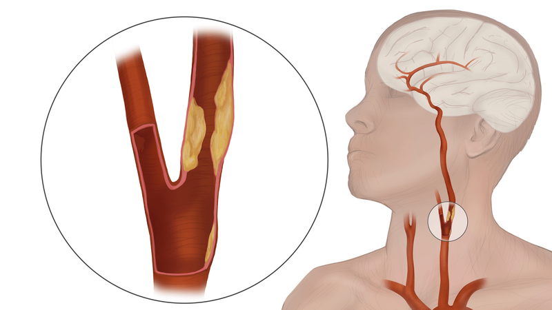 Bệnh xơ vữa động mạch cảnh: Triệu chứng và các biến chứng khôn lường 1