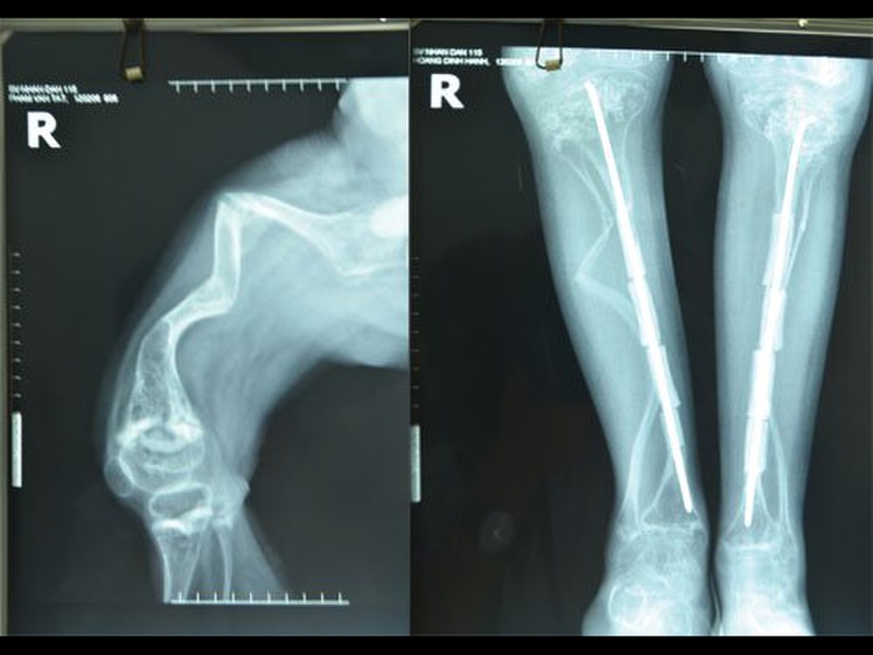 Bệnh xương thủy tinh có chữa được không?