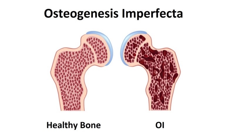 Bệnh xương thủy tinh có chữa được không?1
