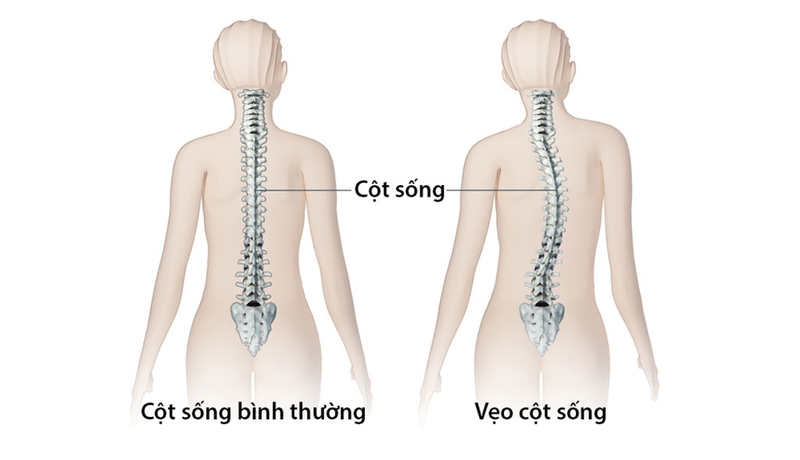 Bệnh xương thủy tinh có di truyền không?1