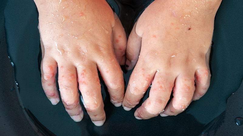 Bệnh zona có lây không? Biện pháp phòng ngừa bệnh hiệu quả 3