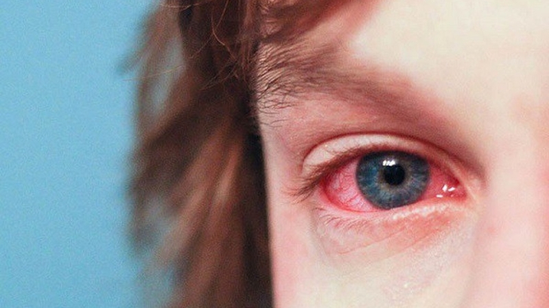 Bệnh zona thần kinh mắt và những điều cần biết 3