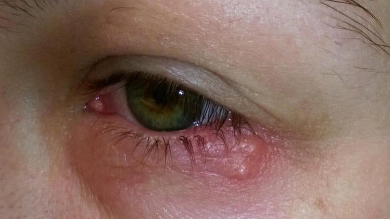 Bệnh zona thần kinh mắt và những điều cần biết 5