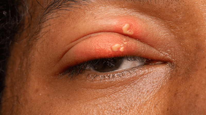 Bệnh zona thần kinh mắt và những điều cần biết 2