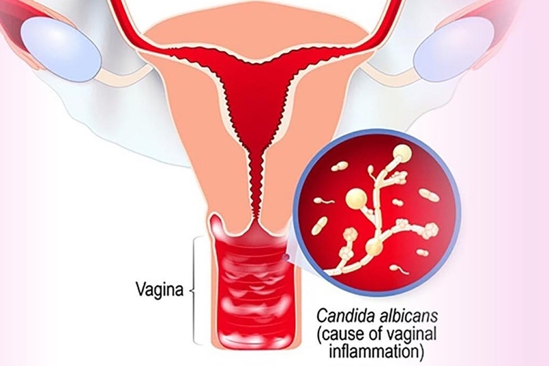 Betadine xanh rửa phụ khoa cách dùng như thế nào là hợp lý nhất? 1
