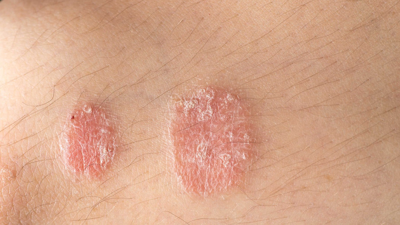 Betamethason dipropionat là gì? Công dụng và cách dùng 4