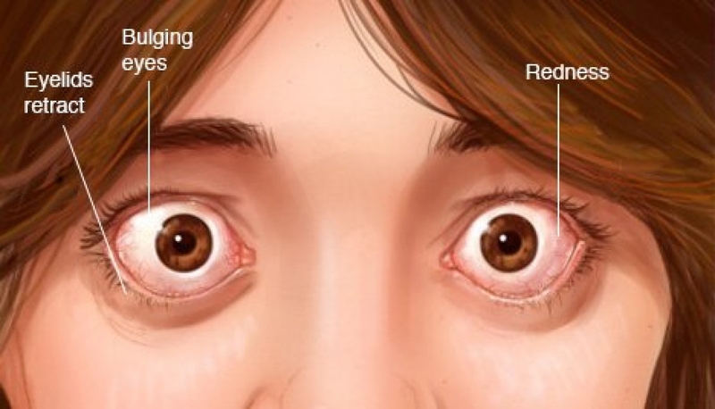 Bướu giáp lan tỏa là gì? Nguyên nhân, triệu chứng và cách điều trị 4