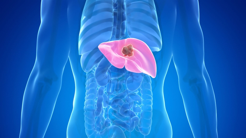 H. pylori và tiền sử gia đình có thể liên quan đến nguy cơ ung thư dạ dày