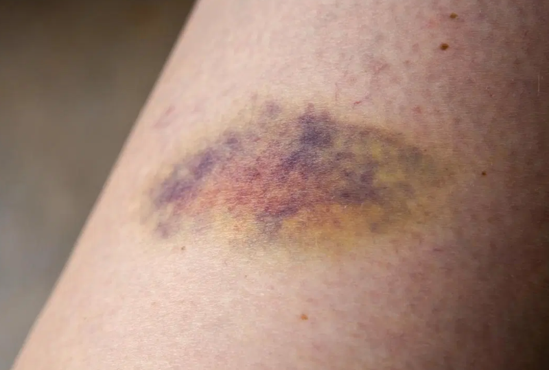 Vết bầm trên da xuất hiện do giảm tiểu cầu miễn dịch ITP