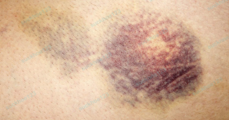 Bị bầm tím do tụ máu sau phẫu thuật