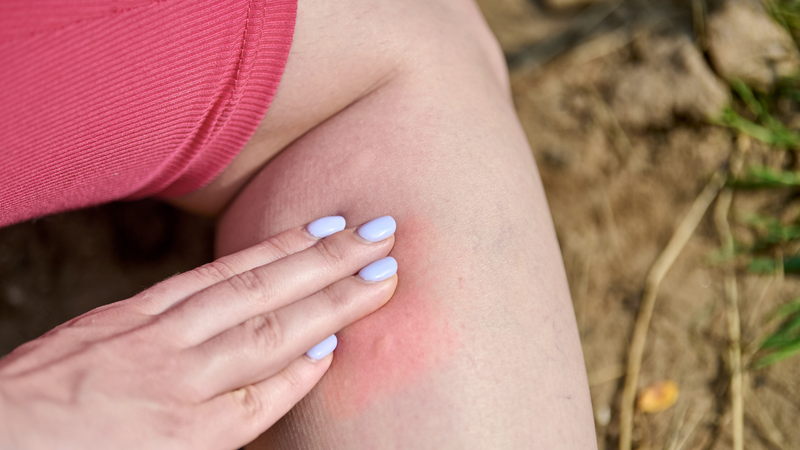 Sưng và đỏ tại chỗ là một trong những triệu chứng ban đầu sau khi bị chích