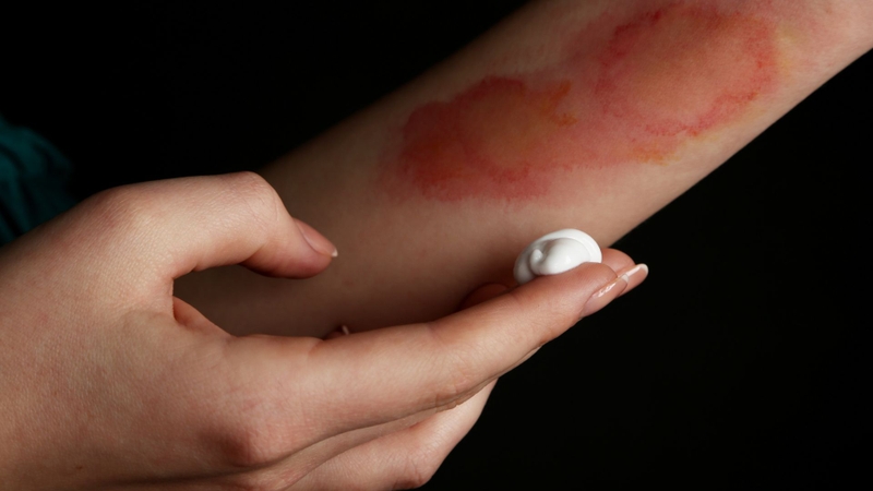 Bị bỏng bôi gì và không nên bôi gì để vết thương nhanh lành? 5