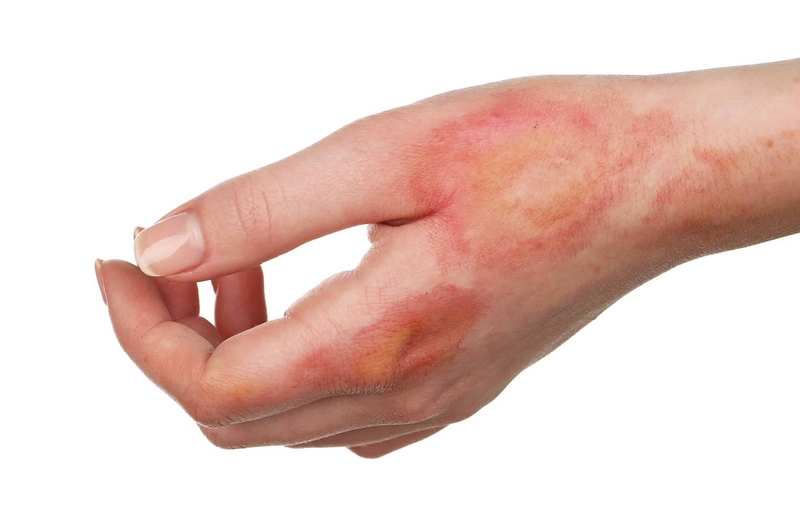 Giải đáp thắc mắc: Bị bỏng bôi Vaseline được không 1