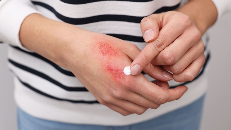 Không nên tự điều trị tại nhà nếu vết bỏng sâu, rộng, do điện hoặc hóa chất