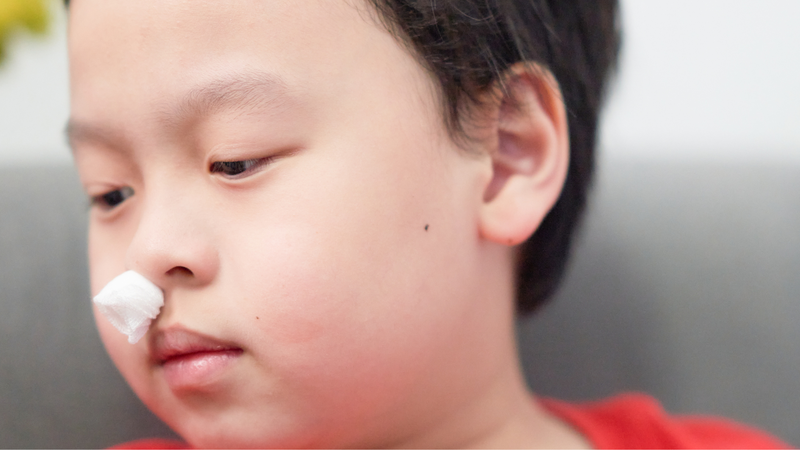 Bị chảy máu cam nên làm gì? Những sai lầm nào cần tránh khi sơ cứu chảy máu cam 2