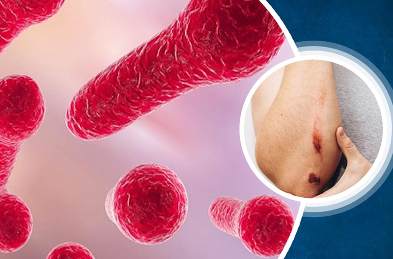 Bị chó cắn có phải tiêm uốn ván không? Có nguy hiểm không? 2