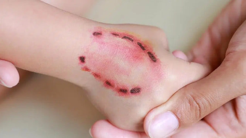 Bị chó cắn có sao không? Nguy hiểm tiềm ẩn sau vết cắn 1